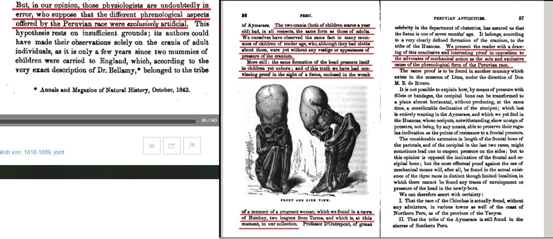 Elongated skull fetus